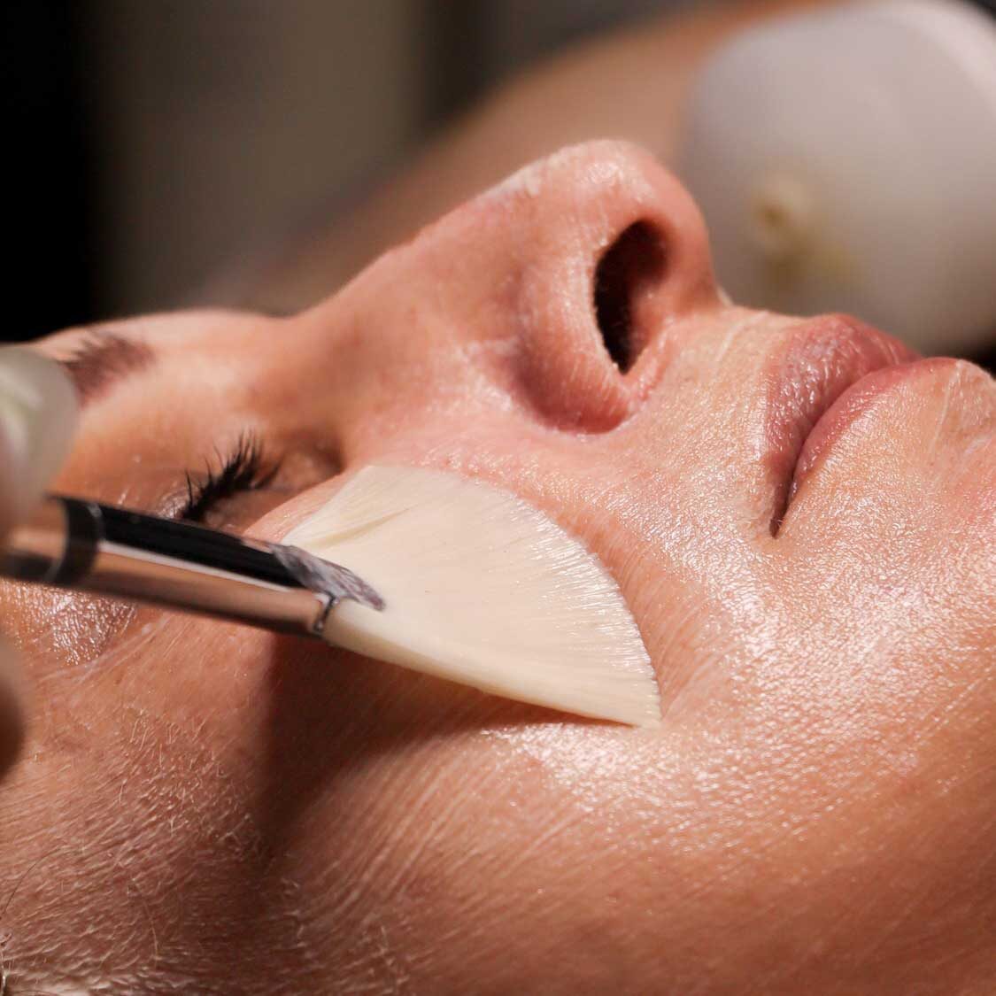 dermaporium-aesthetic-treatments-chemical-peels