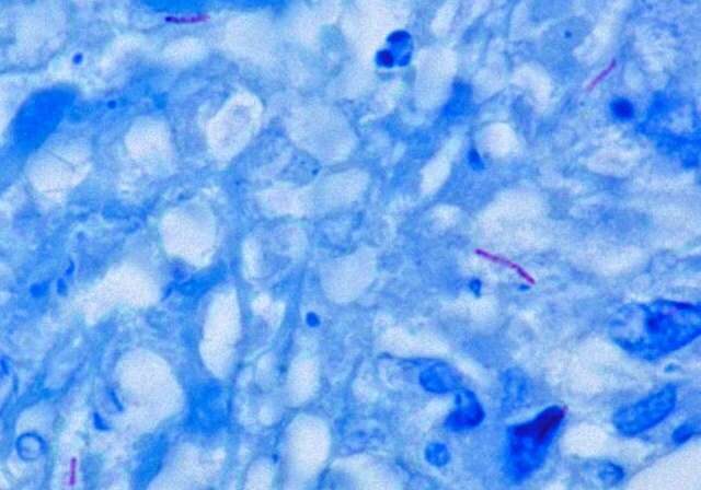 dermaporium-blog-post-tuberculosis