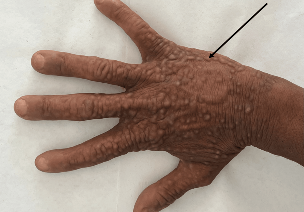 dermaporium-blog-post-verrucous-papules-plaques