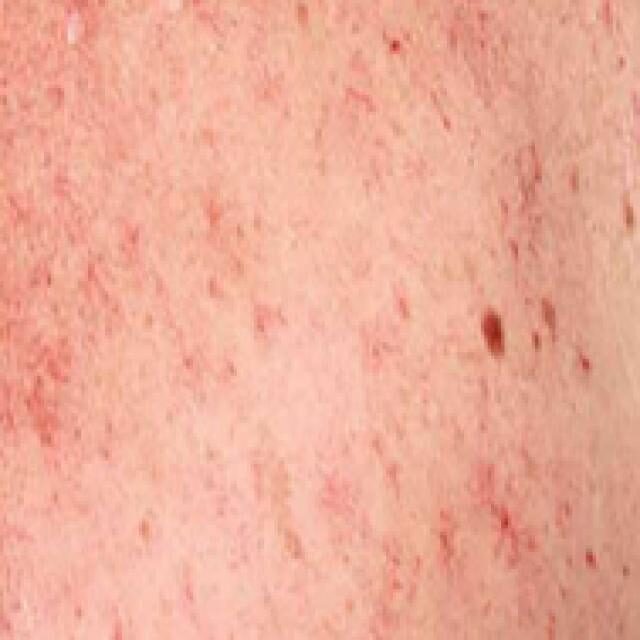dermaporium-medical-dermatology-angiomas
