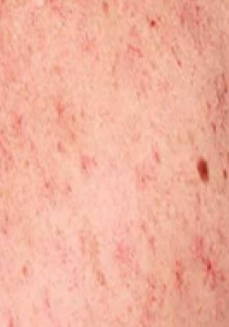 dermaporium-medical-dermatology-angiomas