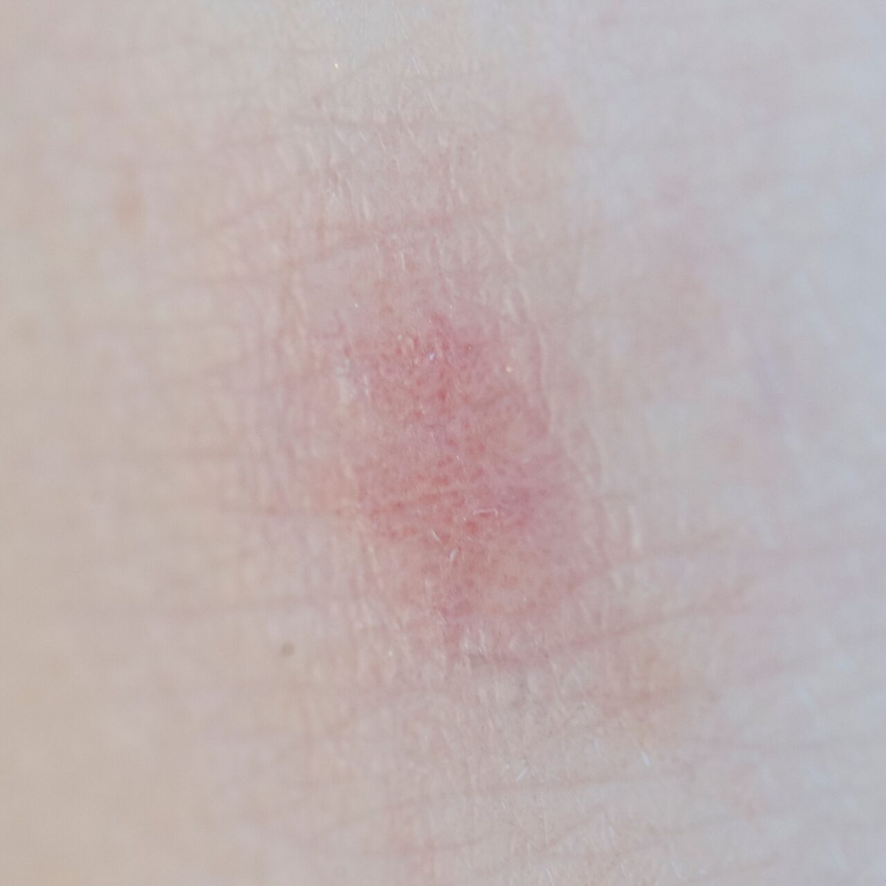 dermaporium-medical-dermatology-contact-dermatitis