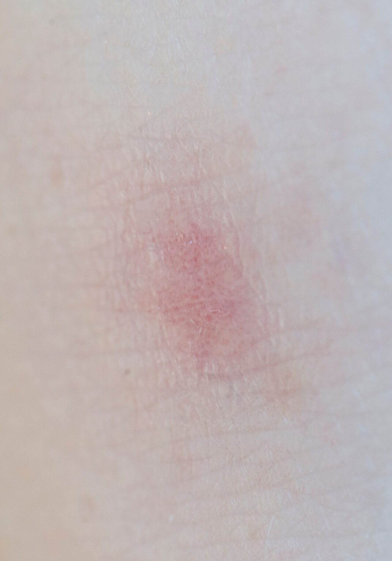 dermaporium-medical-dermatology-contact-dermatitis