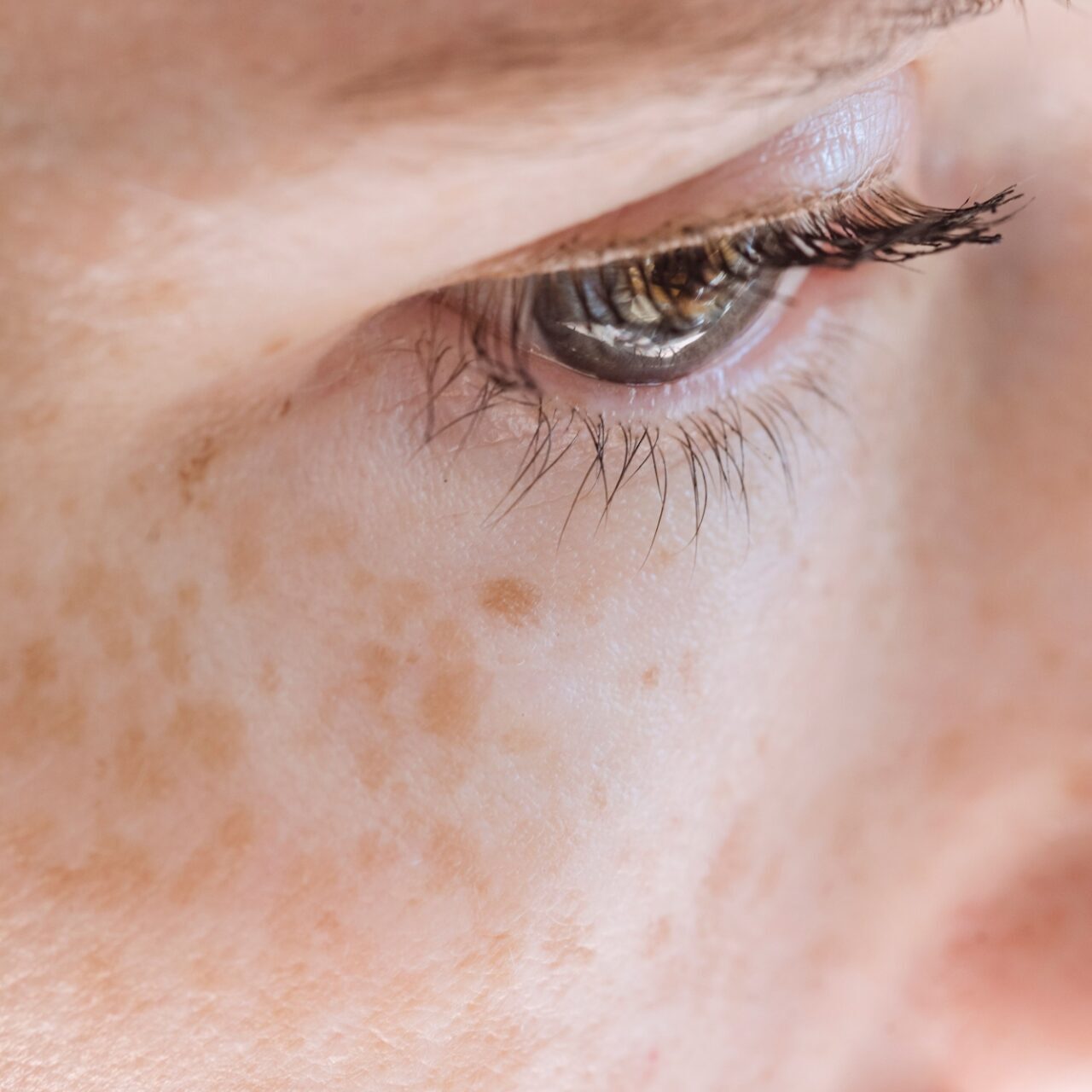 dermaporium-medical-dermatology-hyper-pigmentation