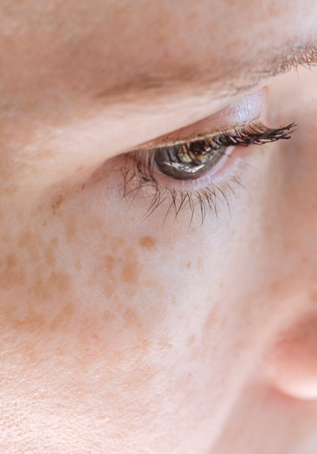 dermaporium-medical-dermatology-hyper-pigmentation