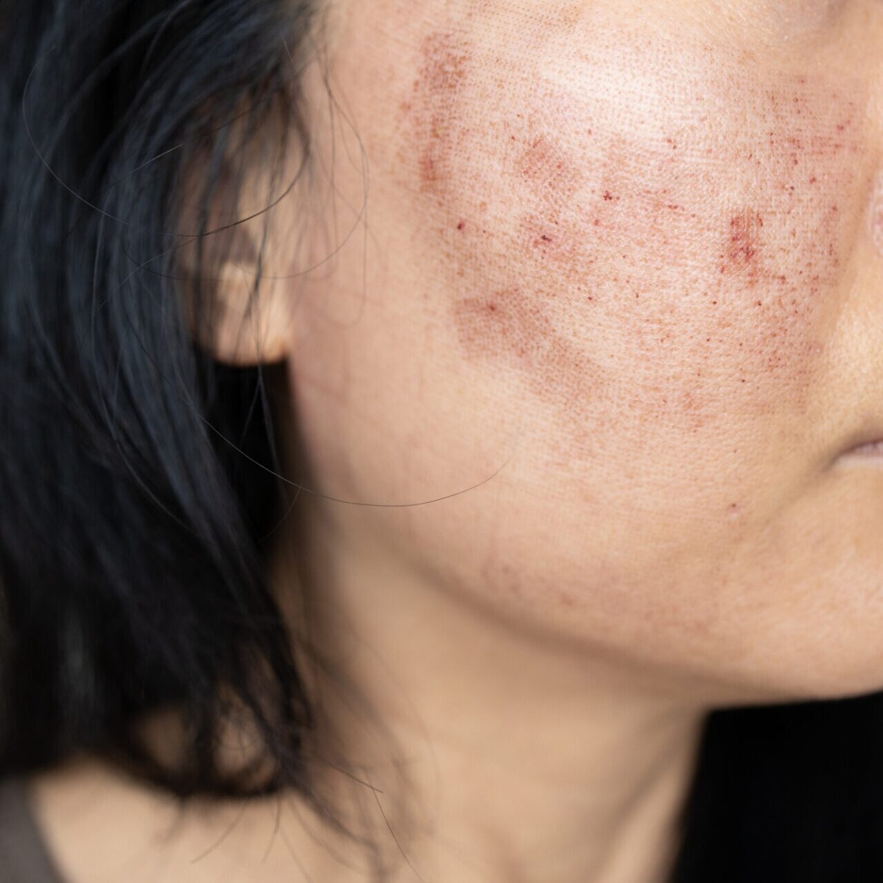 dermaporium-medical-dermatology-melasma