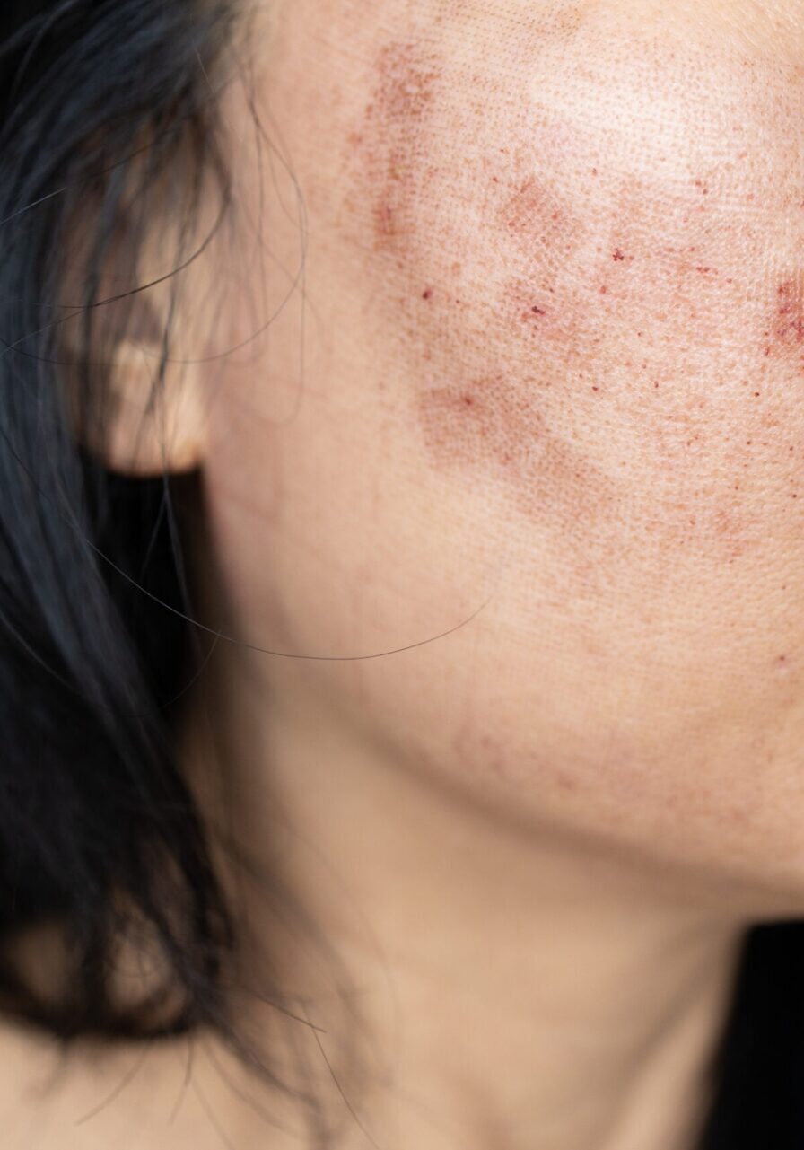 dermaporium-medical-dermatology-melasma