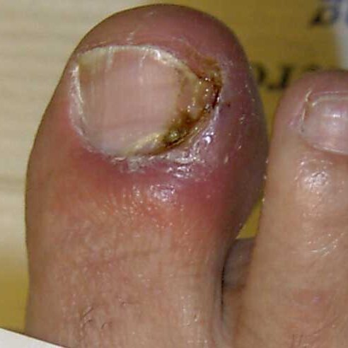 dermaporium-medical-dermatology-nail-disorders