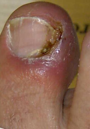 dermaporium-medical-dermatology-nail-disorders