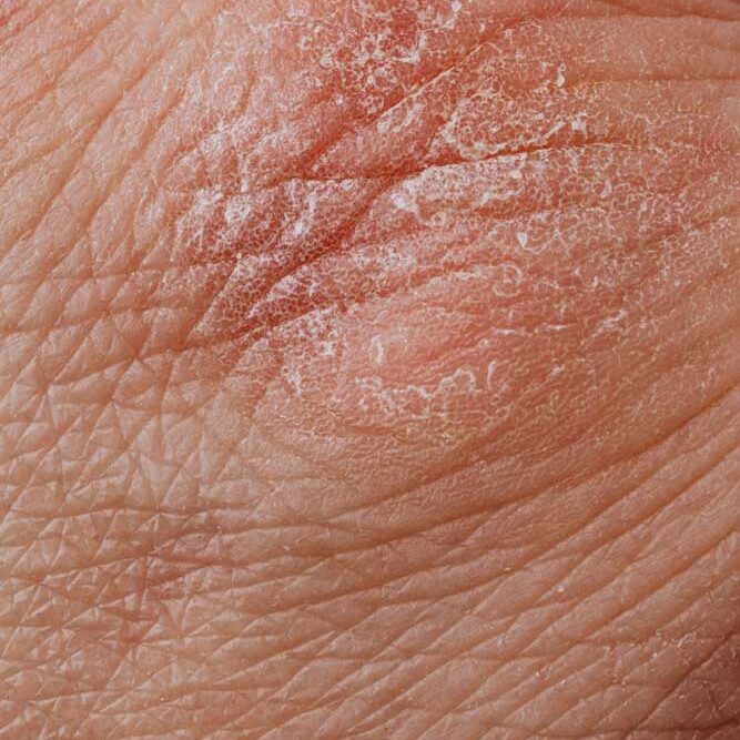 dermaporium-medical-dermatology-psoriasis