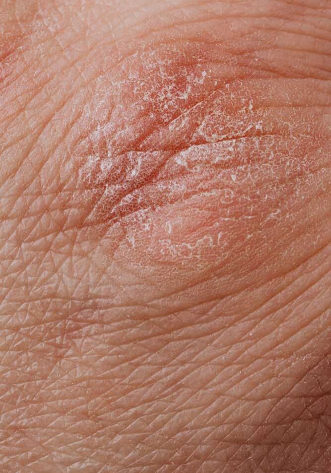 dermaporium-medical-dermatology-psoriasis