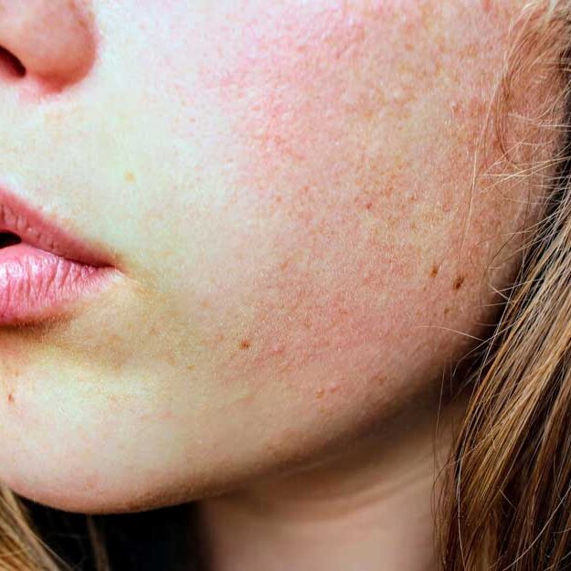 dermaporium-medical-dermatology-rosacea