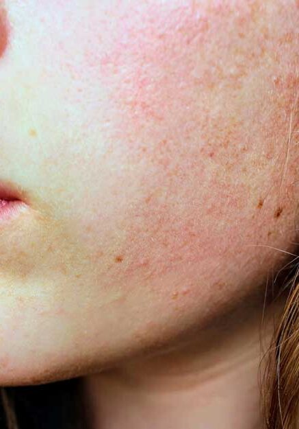 dermaporium-medical-dermatology-rosacea
