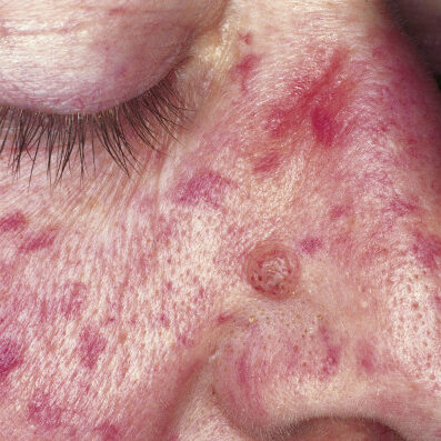 dermaporium-medical-dermatology-telangiectasia