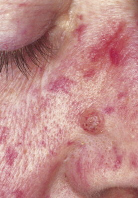 dermaporium-medical-dermatology-telangiectasia