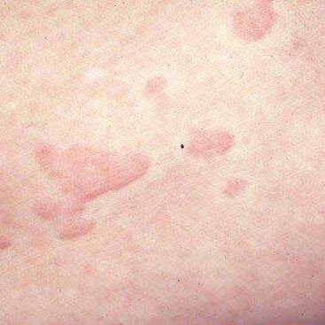 dermaporium-medical-dermatology-urticaria