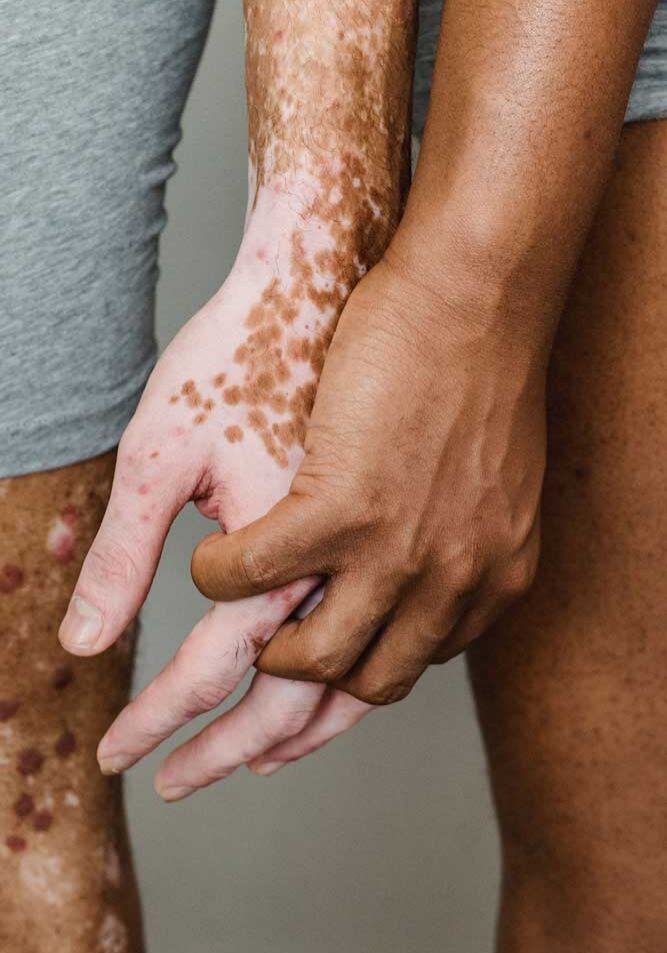 dermaporium-medical-dermatology-vitiligo