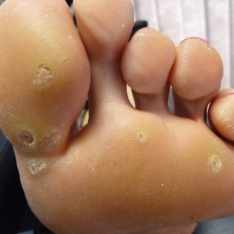 dermaporium-medical-dermatology-warts