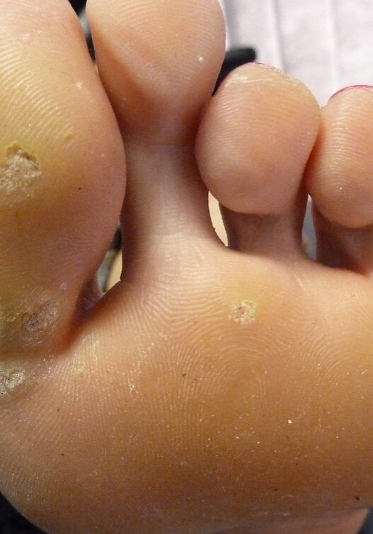 dermaporium-medical-dermatology-warts