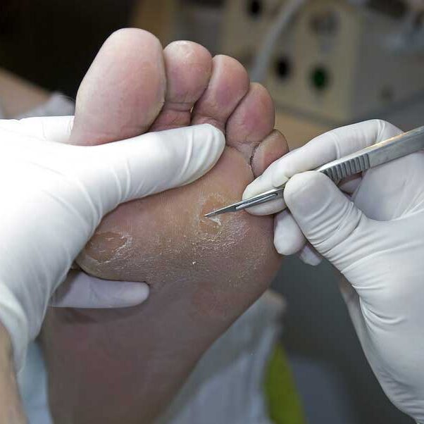 dermaporium-procedures-curettage-cautery