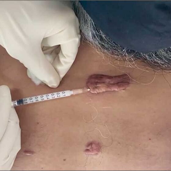 dermaporium-procedures-intralesional-injections