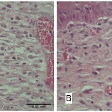 dermaporium-skin-cancer-mole-mapping-biopsy-histological-assessment