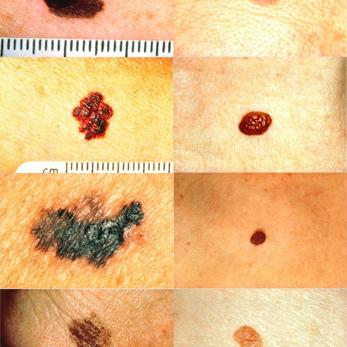 dermaporium-skin-cancer-mole-mapping-digital-mole-mapping