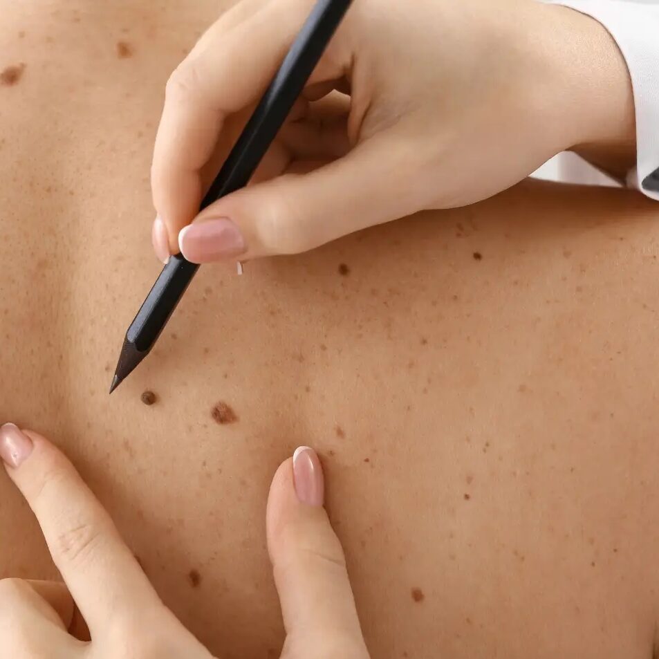 dermaporium-skin-cancer-mole-mapping-full-body-skin-cancer-screening